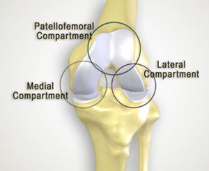 Imagen de la prótesis de rodilla