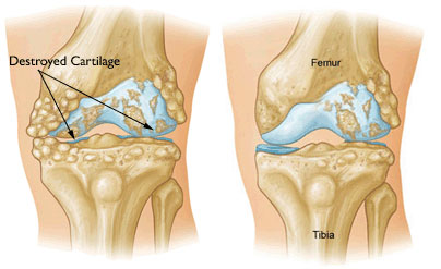 Obrázek náhrady kolenního kloubu