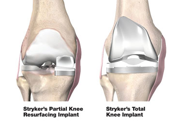 膝関節置換術のイメージ図